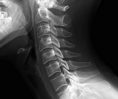 목디스크(본문과 자연스럽게 배치되게 배포 부탁드립니다)