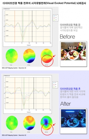 식욕억제사진 뇌파검사1
