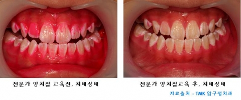 전문가 양치교육(Tooth Pick Technique)전후로 달라진 치아의 치태양상