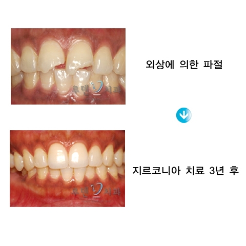 지르코니아 치료 전후
