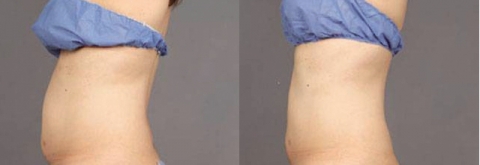 컨투어 사용 전 후 사진