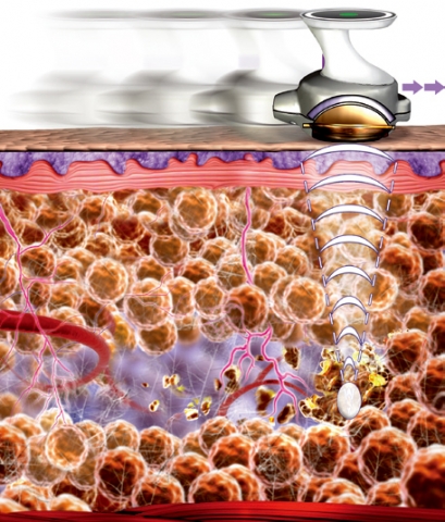 초음파 지방파괴 이미지