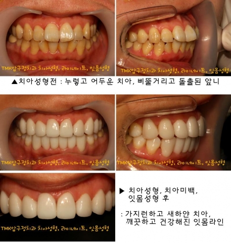 설측교정 마무리 후 라미트 하기 잇몸성형 치아모양성형 연예인치아 치아미백 상담및 시술후기 장단점