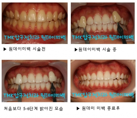 부산치아미백 비포애프터 확인해봐요 - a2 부산치아미백 비포애프터 확인해봐요 - A2