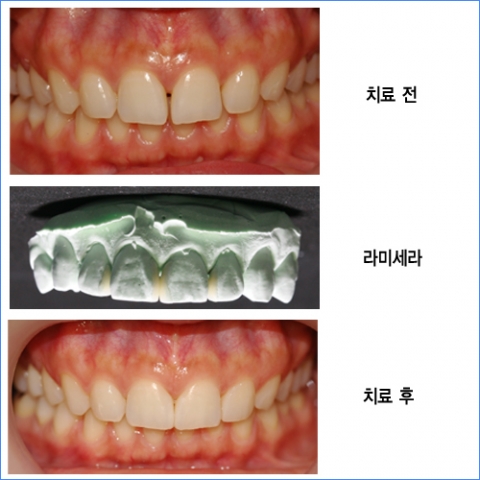 루덴치과, 라미네이트 3분의 1 비용의 라미세라 선보여
