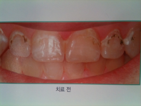아이콘을 이용하여 충치치료하기 전 모습