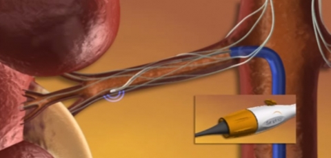 신장 동맥에 접근한 카테타가 고주파 에너지를 혈관벽을 통해 전달, 신장 신경을 차단