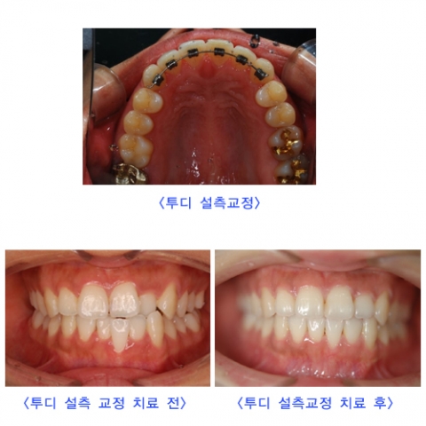 컴퓨터로 정확하고 보이지 않는 교정…인코그니토·인비절라인·투디설측교정