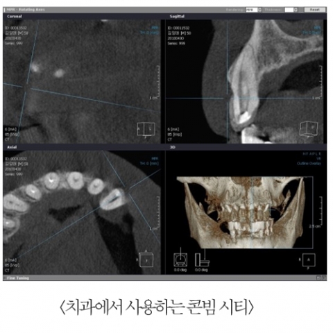 CT 및 현미경을 이용한 신경치료 및 치근단 수술
