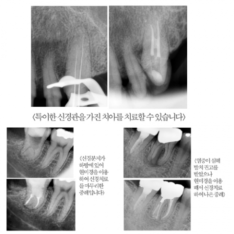 CT 및 현미경을 이용한 신경치료 및 치근단 수술