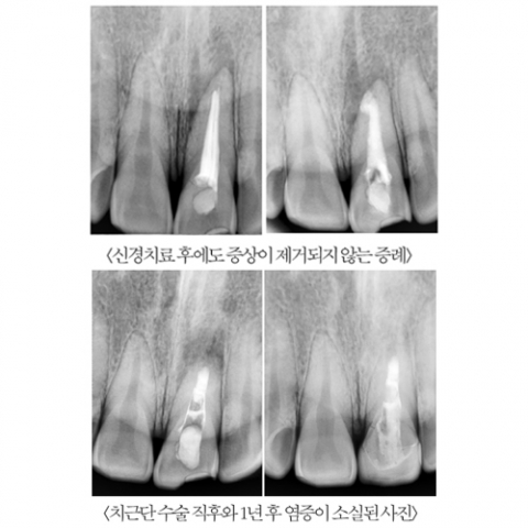 CT 및 현미경을 이용한 신경치료 및 치근단 수술
