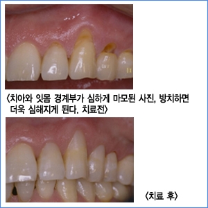 찬물에 이가 시리다면 치경부 마모증을 의심해보세요