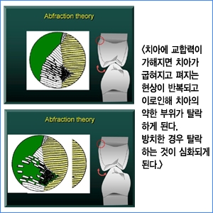 찬물에 이가 시리다면 치경부 마모증을 의심해보세요
