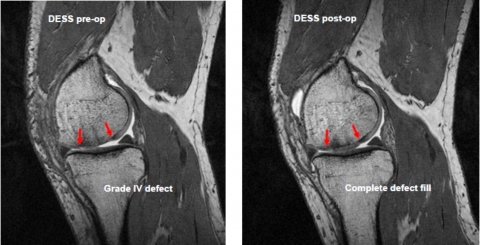카티필(CartiFill, 연골조직수복용 콜라겐 필러)을 이용한 심각한 무릎연골 결손치료 전후의 연골조직 상태(붉은 화살표 지시 부분)를 자기공명영상(MRI)으로 촬영한 모습.  카티필 적용 전, 연골조직 전층이 결손상태(사진 왼쪽)를 보이고 있으나,  카티필 적용 후 1년이 경과한 시점에도 결손부위가 새로운 연골조직으로 완벽히 채워진 상태(사진 오른쪽)를 유지하고 있는 것을 확인할 수 있다(사진출처: ICRS 제10회 국제학술회의 포스터 발표논문 초록).