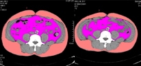 메르의 3D MDCT 내장지방 촬영 사진