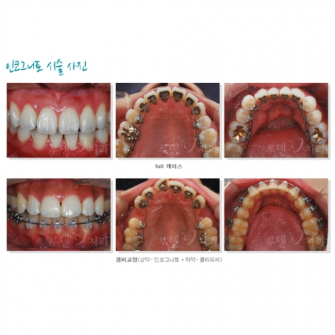 충치걱정 없이 보이지 않게…명품교정 인코그니토