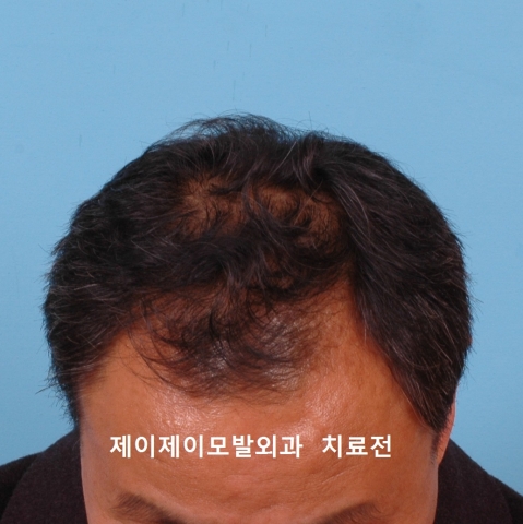 정수리탈모 치료전