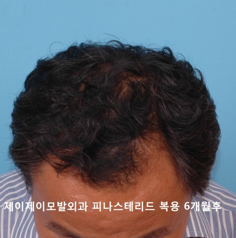 정수리 탈모 피나스테리드 성분약물 치료후