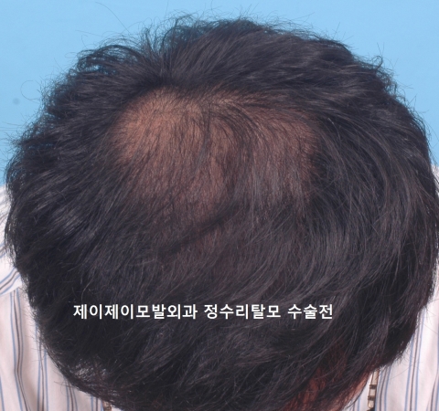 정수리 탈모 수술전