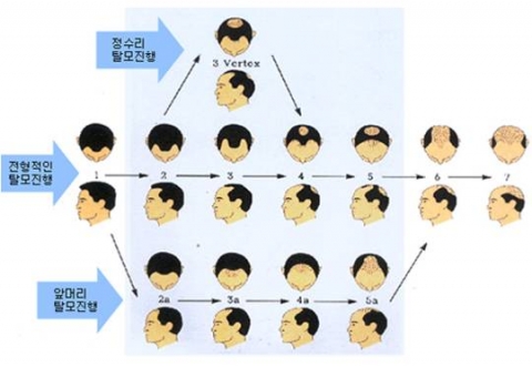 남성형 탈모 진행과정