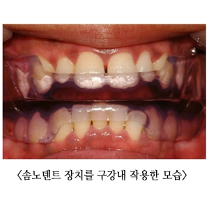 코골이, 수술 부담없이 치과용 솜노덴트 장치로 치료하자