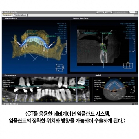 임플란트, 정확한 설계가 중요하다