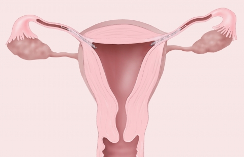 Essure Anatomy
