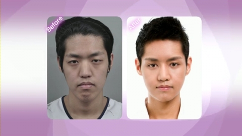 황성민 성형수술 전후