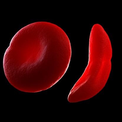 정상 적혈구 세포(좌)와 겸상 적혈구 세포