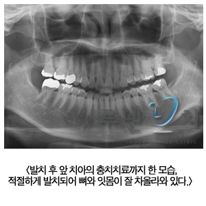 사랑니, 꼭 빼야 하나요