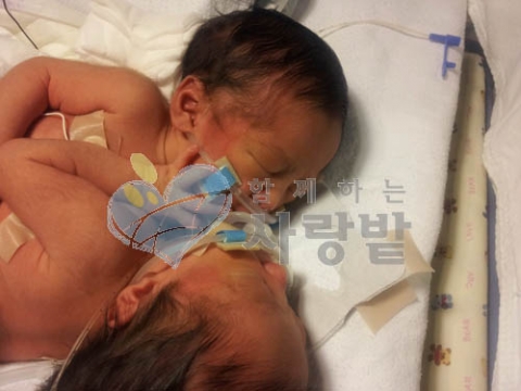 함께하는 사랑밭, 샴쌍둥이를 위한 모금 끝까지 할 것 표명