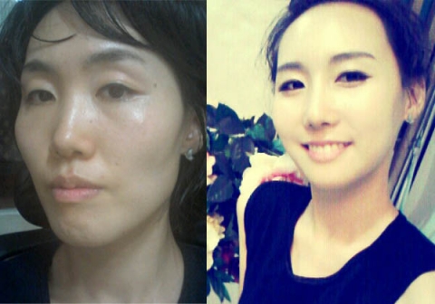 부정교합 ‘노안굴욕녀’ 김채연씨가 양악수술 후 이수경 도플갱어로 변신에 성공해 화제다.