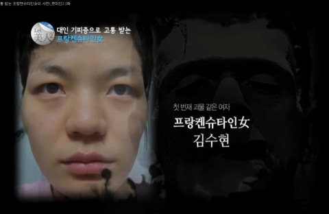 렛미인2에 출연한 프랑케슈타인녀 김수현씨 성형 전 모습