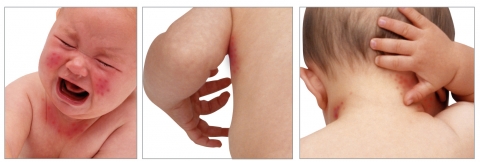 진드기로 인해 피부질환에 고생하는 유아사진