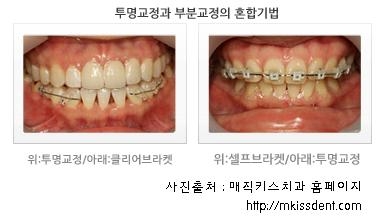 매직키스치과의 투명교정과 부분교정의 혼합기법은 환자별, 케이스별로 선별적으로 이뤄지는 교정기법입니다.