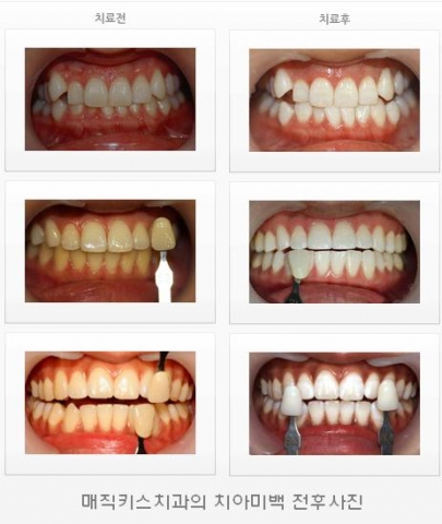 저렴하면서도 더욱 안전하고 강력해진 매직키스치과의 치아미백 전후사진