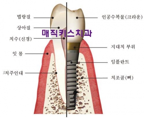 자연치와와 임플란트의 구조 비교설명 자료