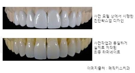 매직키스치과의 라미네이트 제작을 위한 치아모델상에서의 디자인작업 모습