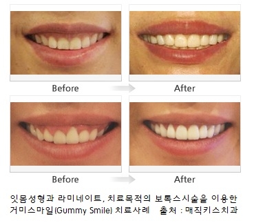 잇몸이 도드라져 보이는 거미스마일 치료 전후사진(이미지출처 : 매직키스치과)