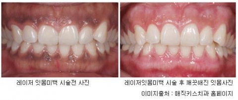 레이저로 하는 간단한 잇몸미백술 전후사진. 레이저로 시행해 5분 이내의 짧은 시술시간 후, 바로 일상생활이 가능한 레이저 잇몸미백 시술