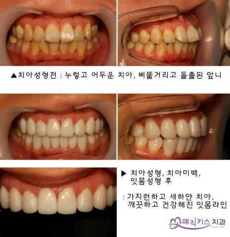 치아성형, 라미네이트, 치아미백, 잇몸성형 시술 직후 가지런하고 깨끗해진 치아와 잇몸의 모습.