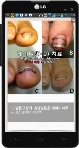 카카오페이지에 등록된 케이디(K-D)치료법