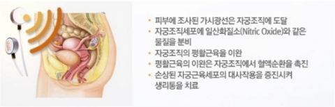 칼라세븐, 생리통 치료기 출시