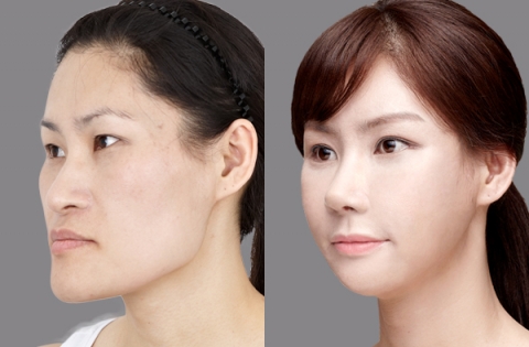 사진제공 - 원진성형외과