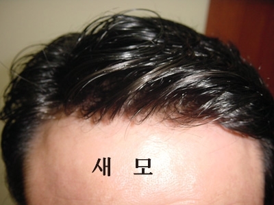 이마 부분만 클로즈업한 사진.