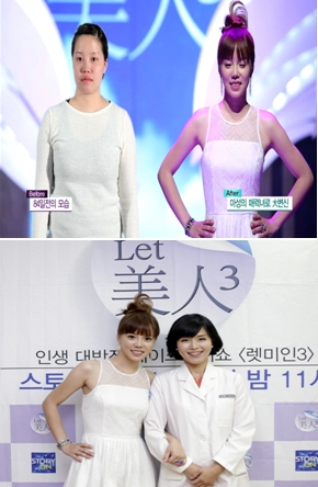 렛미인 치아부식녀 김백주가 김아중 닮은 미코급 성형미인으로 변신하여 네티즌 사이에 화제를 모으고 있다.