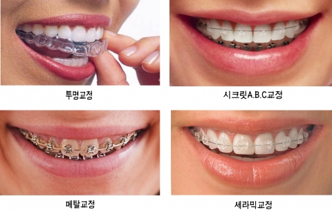 못생긴 앞니, 치아교정으로 해결된다