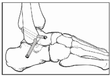 건국대병원 정홍근 정형외과 교수가 발표한 논문 족관절 외측 인대 불안정증에 대한 동종 반건양건과 간섭나사를 이용한 해부학적 재건술. 이 수술법은 세계적인 의학 교과서 캠벨 정형외과