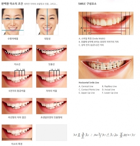 거미스마일을 해소하기 위한 가장 손 쉬운 방법은 바로 잇몸성형이다.