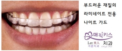 라미네이트전용 나이트가드 치아보호장치가 치아 절반을 덮고 있다.